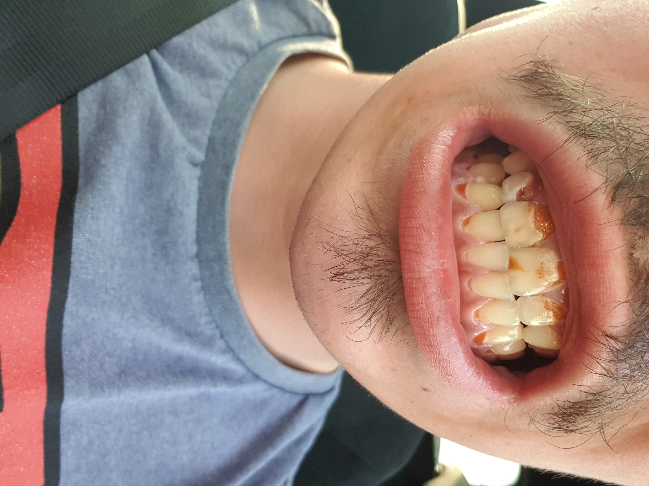 maak een foto Bij wet kennisgeving Heel erg slechte tanden op jonge leeftijd (22) | Tandarts.nl Forum