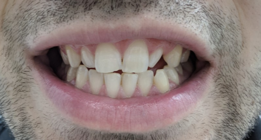 Umeki Voorzichtig Heel Kan ik 1 tand laten rechtzetten met beugel? | Tandarts.nl Forum