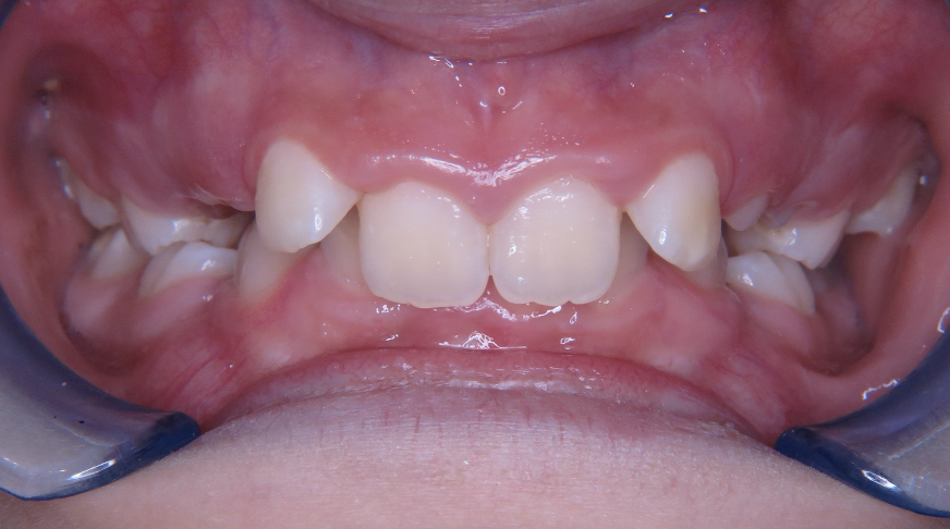 Image for Diepe beet bij kinderen, meer dan een scheve tandstand