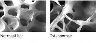 osteoporose 